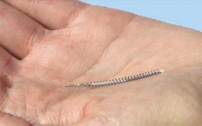 Essure: ¿se sabían realmente los riesgos?